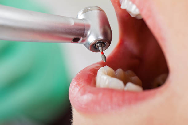 Best Emergency Wisdom Teeth Removal in Tipton, IA